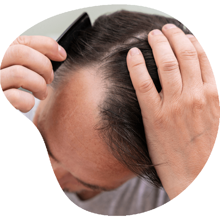 What is a FUE Hair Transplant Turkey?