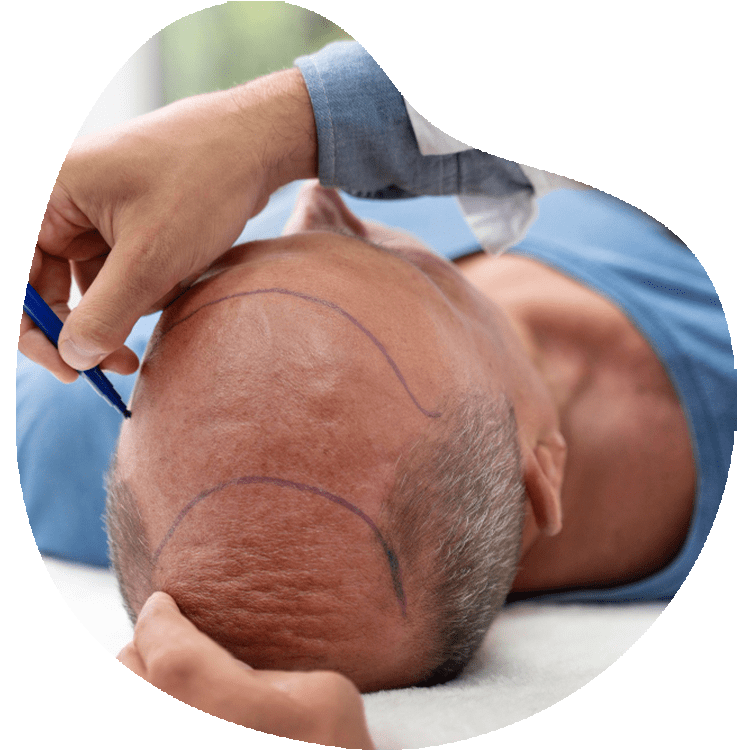 The advantages of the FUE method