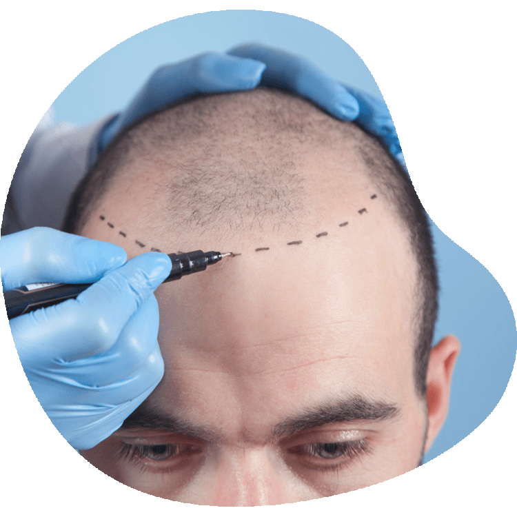 Was ist der Unterschied zwischen FUE- und FUT-Haartransplantationen?