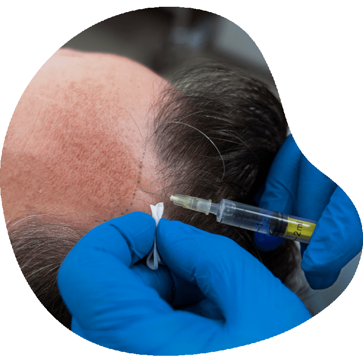 What is a hair transplant in Turkey?