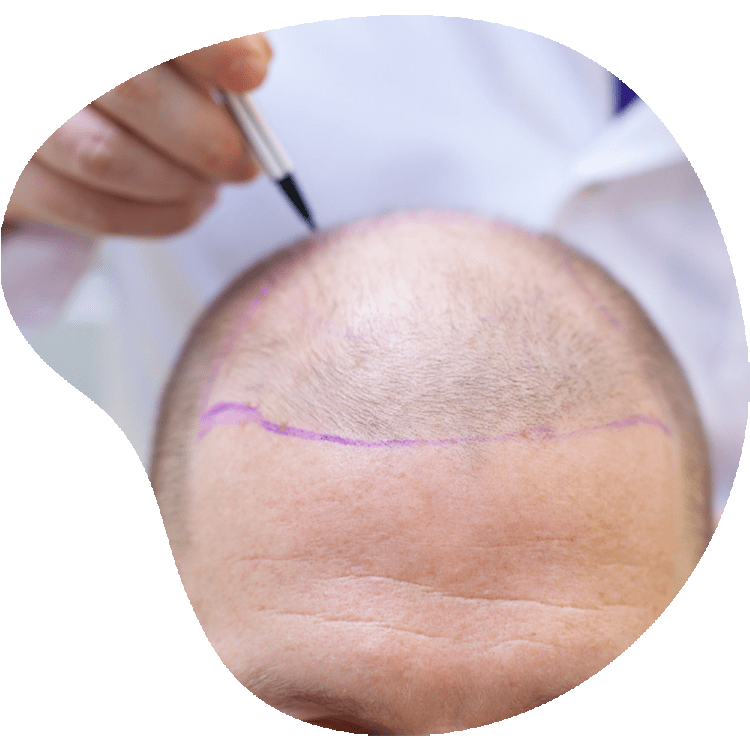 Welche Person ist für eine Haartransplantation ausreichend?