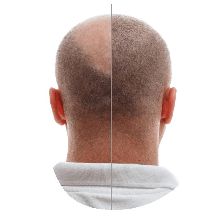 Haartransplantationsverfahren: 8 Schritte
